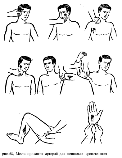 Места прижатия артерий для остановки кровотечения